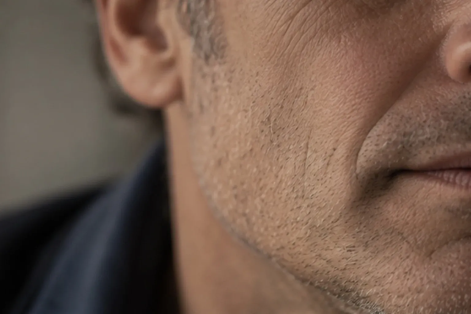Why do some facelifts look operated — while others don't? — Clinic Selnau Zürich
