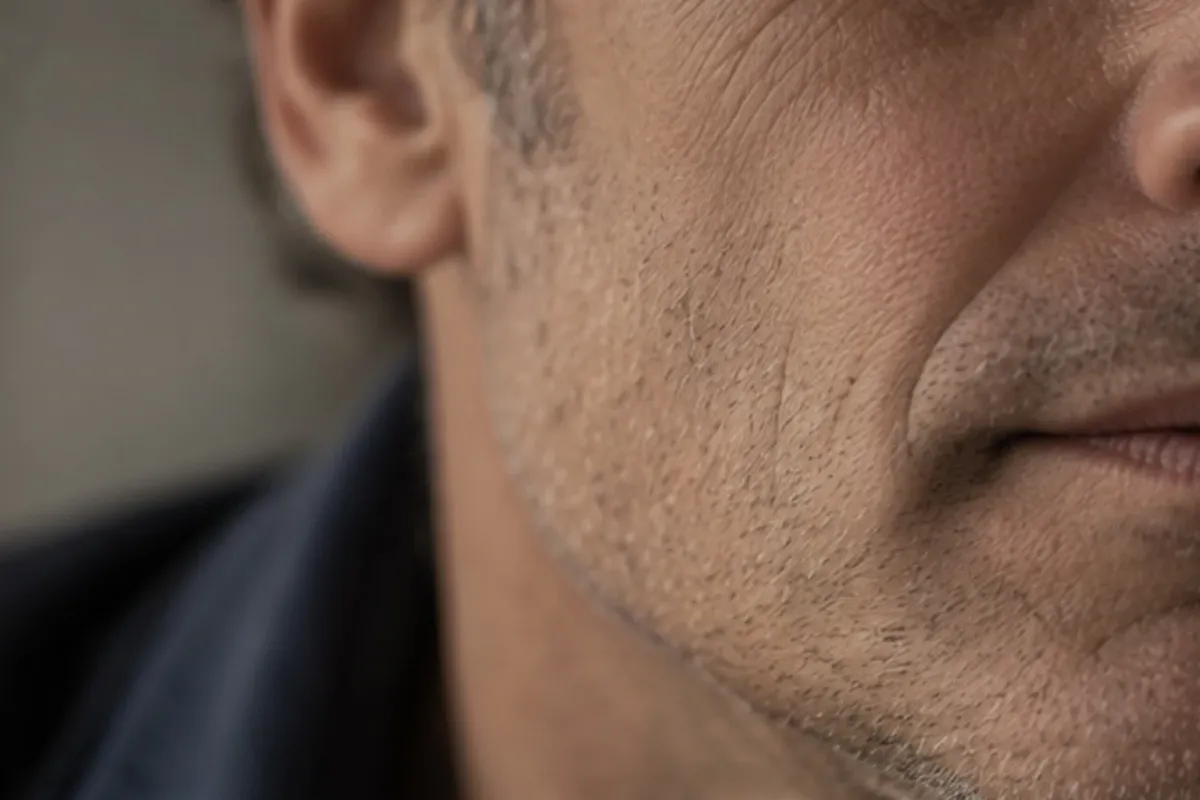 Why do some facelifts look operated — while others don't? — Clinic Selnau Zürich