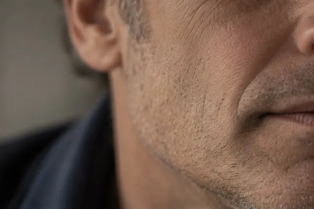 Why do some facelifts look operated — while others don't? — Clinic Selnau Zürich