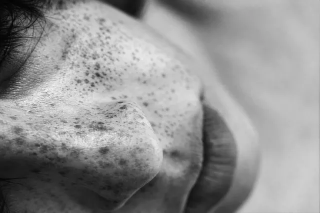 When is rib cartilage needed in revision rhinoplasty? — Clinic Selnau Zürich